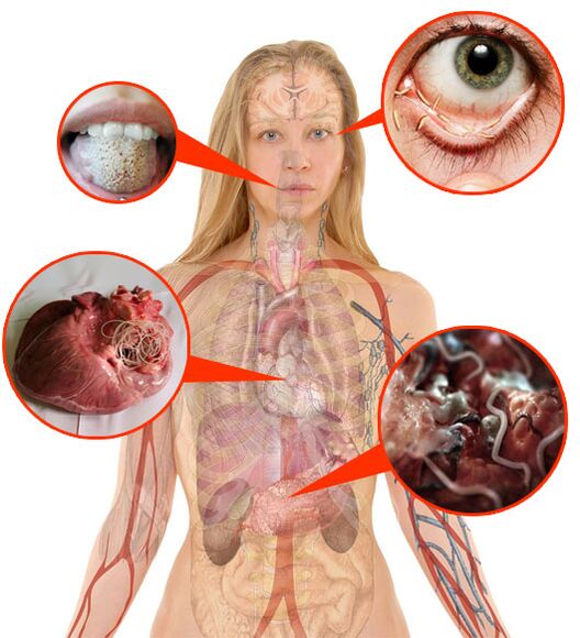 Parasites et vers dans le corps humain